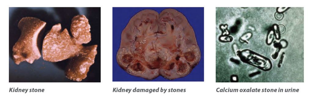 kidney stones; kidney damaged by stones; calcium oxalate stone with urine;